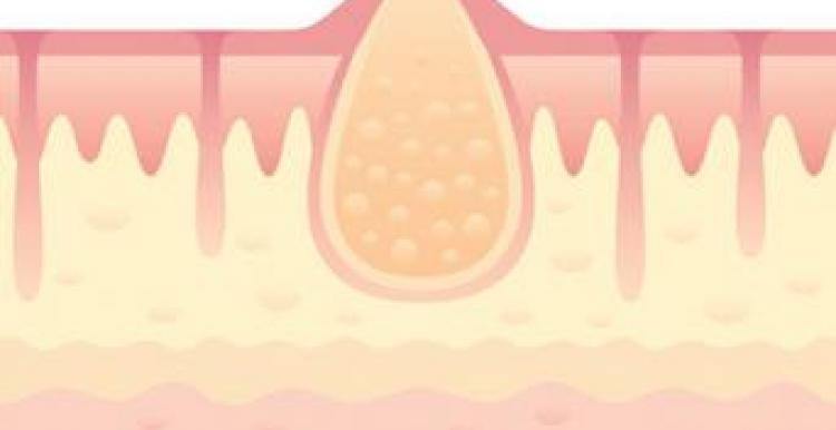 Skin abscess graphic