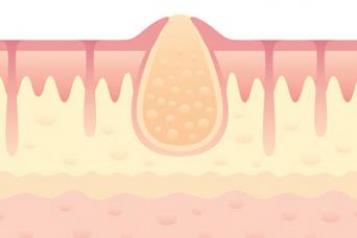 Skin abscess graphic